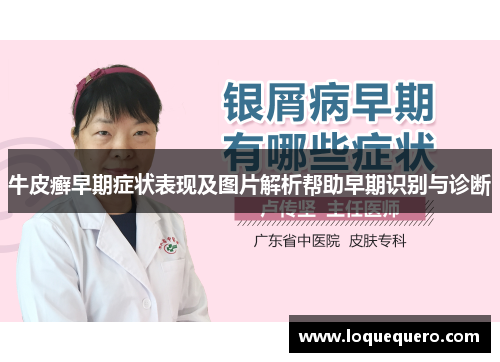 牛皮癣早期症状表现及图片解析帮助早期识别与诊断